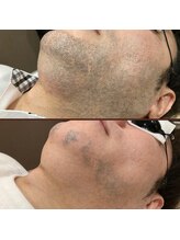 メンズキュー(Men's Cue)/脱毛4ヶ月