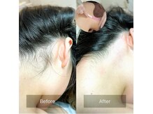 【最新の高濃度プラセンタ光脱毛／ワックス脱毛】全員3,500円!