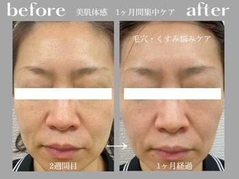 アイレ 桑名(aire)/毛穴/黒ずみ毛穴/くすみ/美白/