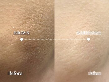 エメ 名古屋栄店(aimer)/LEMELLA <メラニンケア>