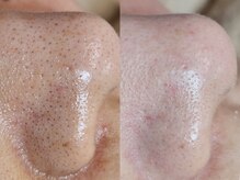 脱毛サロン ベル(Bell)/毛穴ケア