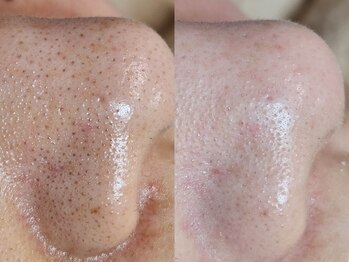 脱毛サロン ベル(Bell)/毛穴ケア