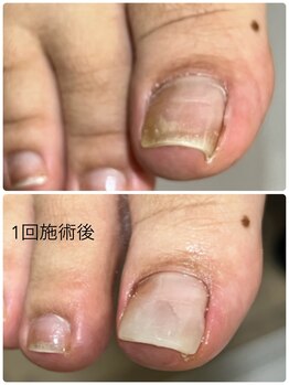 シーディーエム ジュエ(cdm jouer)/巻き爪補正