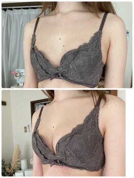 サロン ド チョコ(SALON DU CHOCO)/【バストアップ】症例