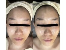 シャルム(CHARME)/小顔矯正＋EMS