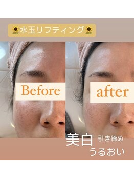 ティパニボーテ(Tipani Beaute')/韓国美容肌管理