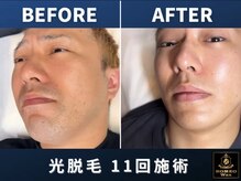 ロミオワックス ジュリエットワックス 新宿店(ROMEO Wax Juliet Wax)/ひげ脱毛で10歳若返った印象に♪