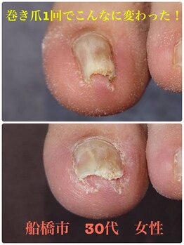 巻き爪じゅん 船橋店/巻き爪早くに来ればよかった！