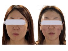 リズ(rE:S)/韓国インモードリフティング30代