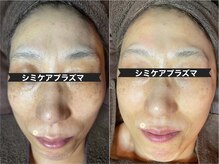 サロン フェリシア(salon Felicia)の雰囲気（シミでお悩みの方に！シミプラズマでターンオーバー透明感もUP！）
