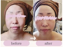 アンカシェット(en cachette)/小顔フェイシャル