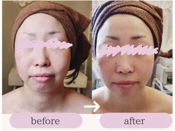 アンカシェット(en cachette)/小顔フェイシャル