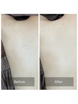 アーユルヴェーダアンドアロマエステ アユス(AYUS)/ハーブピーリング背中