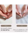 広がっている爪も矯正