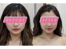 フェミニー(Feminy)/【小顔整顔リフト】輪郭くっきり