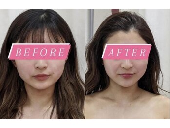 フェミニー(Feminy)/【小顔整顔リフト】輪郭くっきり