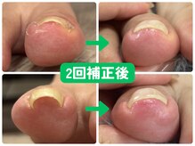 爪のいろは/見た目も綺麗に♪巻き爪補正