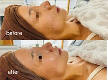 ルーク(Luke)/ハーブピーリング　before after