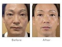 マリーローランメンズグレース(Marryrolan MensGrace)/リベルピーリング症例