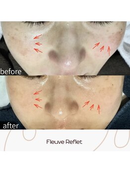 フルーヴ ルフレ(Fleuve Reflet)/くすみでお悩みの方へオススメ