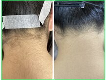 クリア 尾張旭店(Clear)/【Clear脱毛ビフォーアフター】