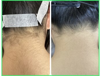 クリア 尾張旭店(Clear)/【Clear脱毛ビフォーアフター】