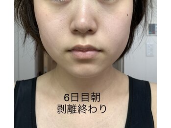 エステティック レイビス 池袋店(RAYVIS)/ハーブピーリング6日後朝