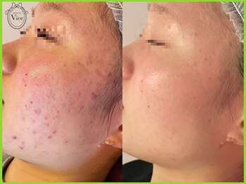 ヴィオール 名古屋栄店(VIOR)/ハーブピーリング