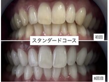 ホワイトニングショップ 明石大久保店/【BeforeAfter】