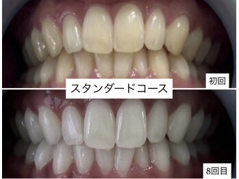 ホワイトニングショップ 明石大久保店/【BeforeAfter】