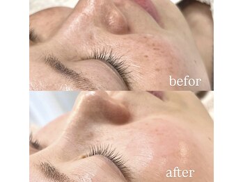 ビタザボナ(Vita the Bona)/幹細胞フェイシャル