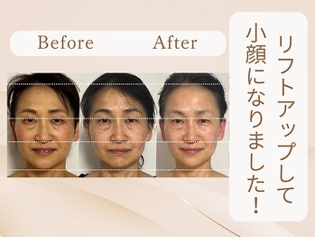 美カナエル(美kanaeru)/シミケア&小顔ケアに変更