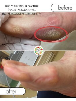 フローラ(Flora)/タコ、角質、かかとのケア