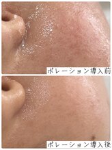 ベルエクラ(Bel Eclat)/エレクトロポレーション