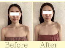 リコ(Rico)/挙式に向けて顎先シャープに