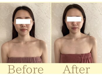 リコ(Rico)/挙式に向けて顎先シャープに