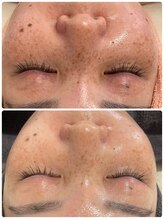 サロンドエテ(salon de ete)/シミへアプローチし予防していく