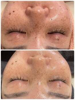 サロンドエテ(salon de ete)/シミへアプローチし予防していく