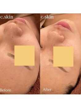 シースキン 盛岡駅前店(c.skin)/お客様ビフォーアフター