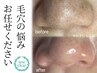 【頑固な黒ずみお任せあれ】根深い黒ずみも除去します　　初回体験6,050円