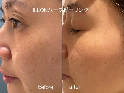 リリラース(Lililas)の写真