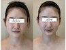【本物の小顔矯正】‐更に小顔へしっかり整えたい方へ‐【OPEN記念割】