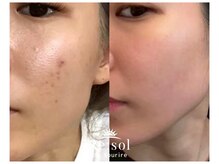 リソルバイスリール(Re:sol by sourire)/Re:sol ハーブピーリング専門店