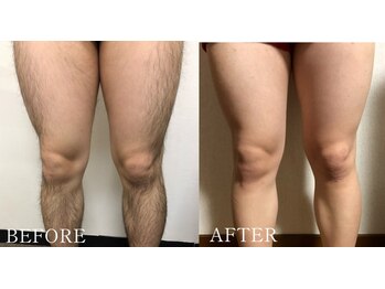 トータルビューティサロン シェリ(cheri)/メンズ脱毛