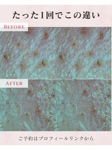 ル シャ/メンズ脱毛/毛穴洗浄/ヘッドスパ