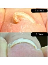 まき爪晴れる/早く見つける事が大切です