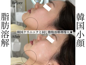 リベルキョウト 京都駅前店(Liber Kyoto)/レモンボトル超え!二重顎撃退