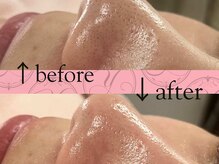 パッチ バイ サロンデヤンス(Patch by SALON DE YANSU)/毛穴スッキリ