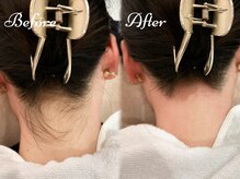 ピミル(PIMIL)/うなじ脱毛