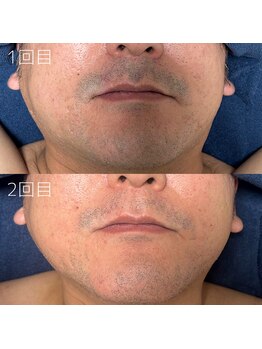 カナウ(KANAU)/ヒゲ脱毛（40代後半男性）